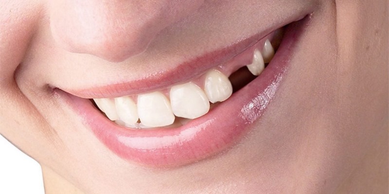 Tại sao xuất hiện giấc mơ thấy răng rụng?